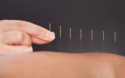 Acupuncture in Toronto: An Ancient Solution to Modern Conditions