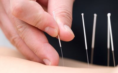 Benefits of Acupuncture Therapy as a Stand-Alone or Support Treatment