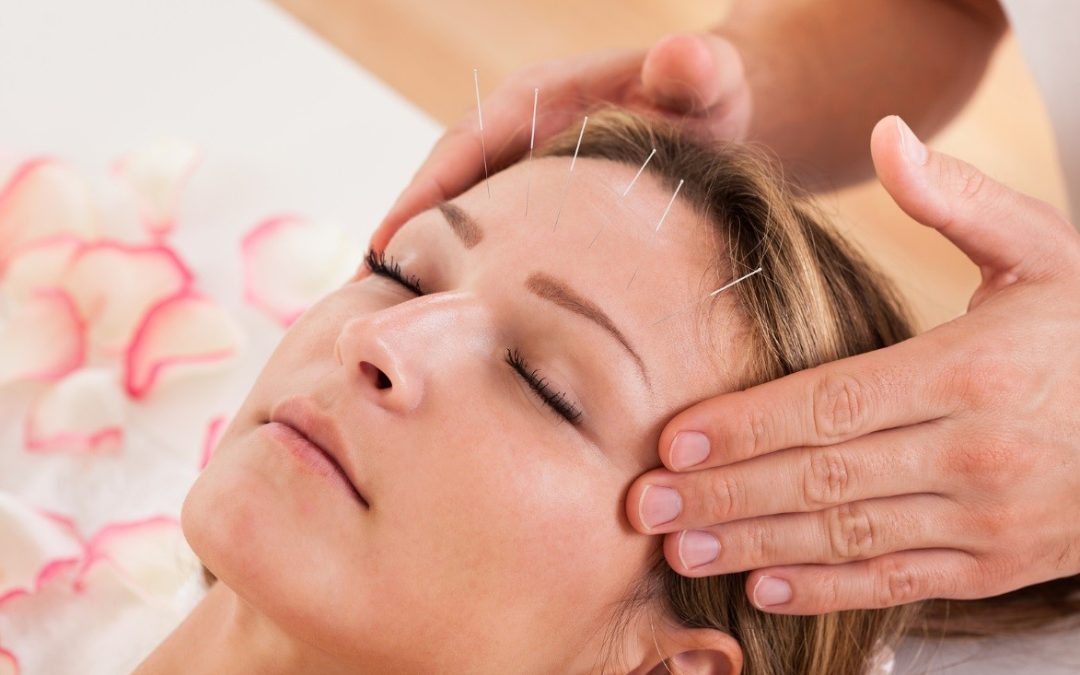 acupuncture
