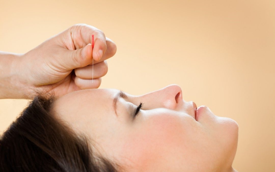 acupuncture