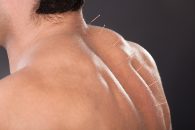 How Toronto Acupuncture Specialists Can Help in Treating Back Pain